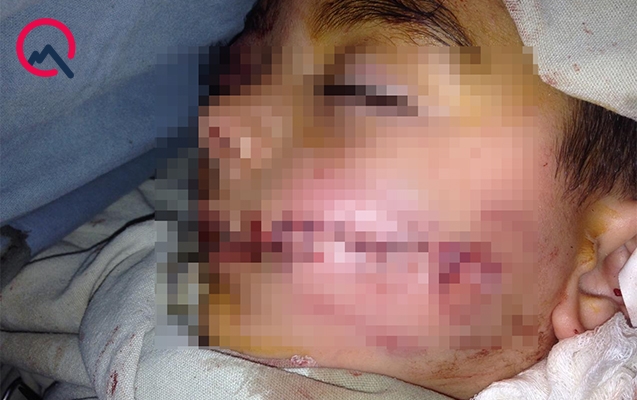 “İt Hüseynin üzündən yapışaraq bir neçə metr sürüyüb”